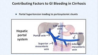 Esophageal Varices and Variceal Hemorrhage [upl. by Rolat559]