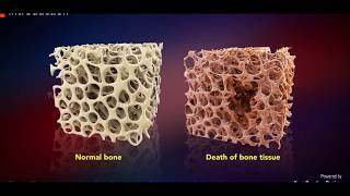 Avascular Necrosis  Core Decompression [upl. by Philander]