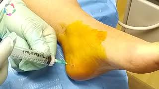 Painfree steroid injection by Podiatrist in UK for plantarfasciitis  heel pain [upl. by Seline]