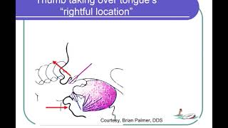 e190 Preview Orofacial MyologyTongue Thrust  An Introduction With Assessment Applications [upl. by Idnem]