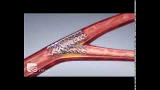 3D Visualisation  Balloon Angioplasty [upl. by Joachim]