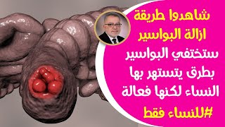 شاهدوا طريقة ازالة البواسيرللمرأة ستختفي البواسيربطرق تستهتربها السيدات لكنها فعالة في علاج البواسير [upl. by Holbrooke217]