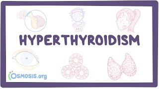 Hyperthyroidism  an Osmosis Preview [upl. by Aleakim]