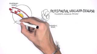 Cardiovascular Disease Overview [upl. by Barnet]