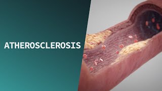 Atherosclerosis  Pathologies [upl. by Rotow]