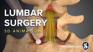 Lumbar Surgery  Laminectomy  3D Medical Animation [upl. by Rimat133]