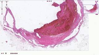 Atheromatous Plaque with Thrombosis  Histopathology [upl. by Sisxela]