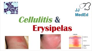 Cellulitis vs Erysipelas  Bacterial Causes Risk Factors Signs and Symptoms Treatment [upl. by Lightman]