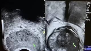 biopsia próstata com fusão de imagens [upl. by Firahs]