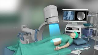 Core Decompression for Avascular necrosis of HipAVN [upl. by Flieger]